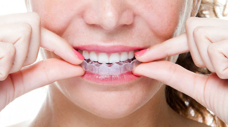 phương pháp niềng răng Invisaglin là gì