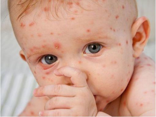 Bệnh sởi sẽ trở nên nguy hiểm nếu không được chăm sóc đúng cách. bênh sởi có nguy hiểm không?