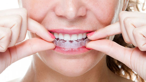 Phương pháp niềng răng invisalign 1