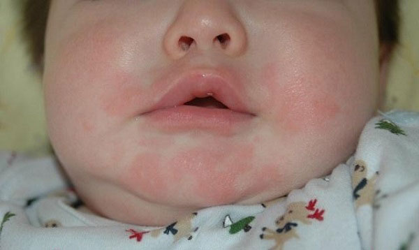 trẻ bị mần đỏ quanh miệng 2