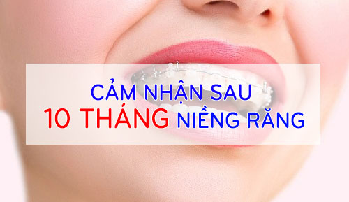 [ Chia sẻ ] Cảm nhận sau 10 tháng niềng răng của cô gái nặng 41kg