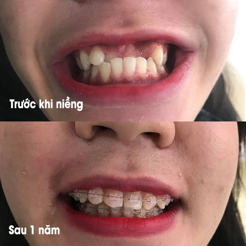 Niềng răng có đẹp hơn không (4)