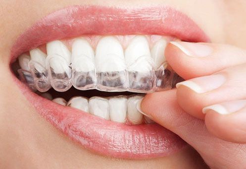 Khay nhựa niềng răng an toàn tuyệt đối