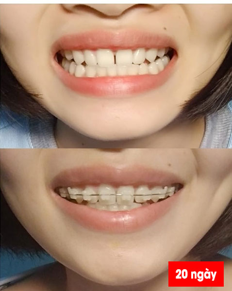 Niềng răng có đẹp hơn không (2)