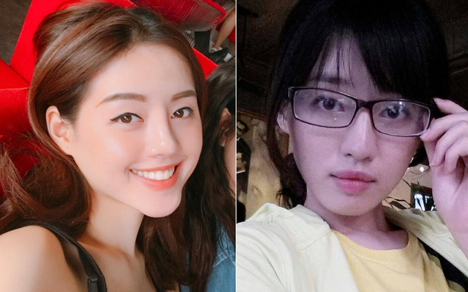 Niềng răng sẽ đẹp như thế nào