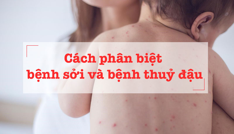 Bị sởi có bị thuỷ đậu không? Cách phân biệt bệnh sởi và thủy đậu