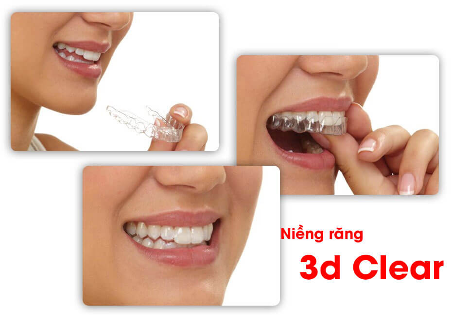Niêng răng 3D Clear là gì