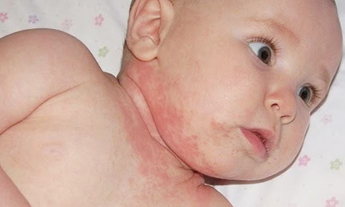 Trẻ bị chàm do ngoại lực hoặc nội sinh với nhiều nguyên nhân khác nhau Trẻ bị chàm do ngoại lực hoặc nội sinh với nhiều nguyên nhân khác nhau