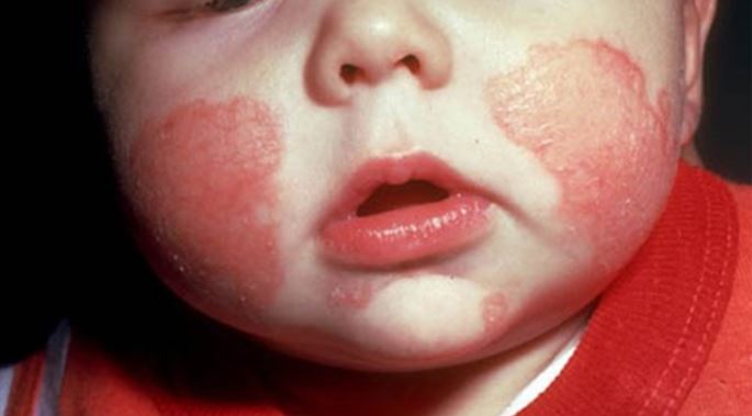 Chàm khô xuất hiện ở má của trẻ Chàm khô xuất hiện ở má của trẻ