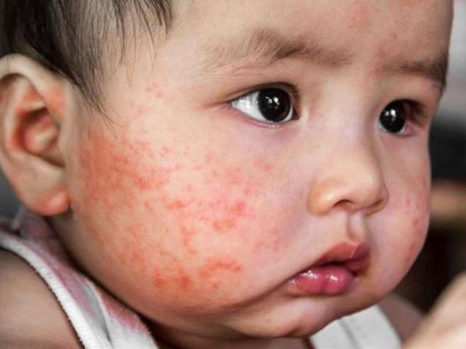 Bệnh chàm là căn bệnh ngoài da Bệnh chàm là căn bệnh ngoài da