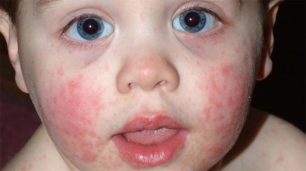 Chàm sữa được xác định do nhiều nguyên gây lên trong đó có yếu tố di truyền Chàm sữa được xác định do nhiều nguyên gây lên trong đó có yếu tố di truyền
