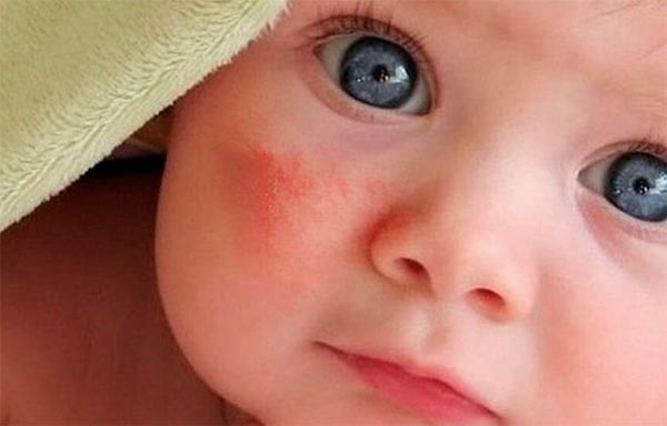 Dấu hiệu của bệnh chàm sữa ở trẻ nhỏ? Dấu hiệu của bệnh chàm sữa ở trẻ nhỏ?