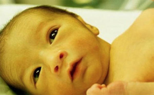 Bệnh vàng da ở trẻ nhỏ là gì? Bệnh vàng da ở trẻ nhỏ là gì?