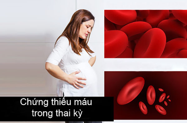 Bệnh thiếu máu thai kỳ Bệnh thiếu máu thai kỳ