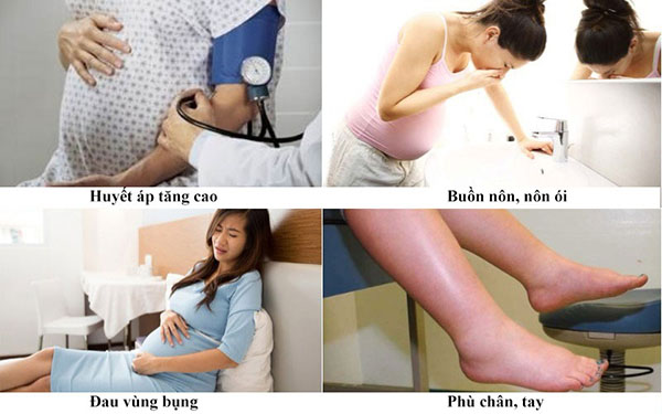 Triệu chứng tiền sản giật khi mang thai Triệu chứng tiền sản giật khi mang thai