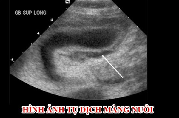 Tụ dịch mang nuôi có tự khỏi không? Tụ dịch mang nuôi có tự khỏi không?