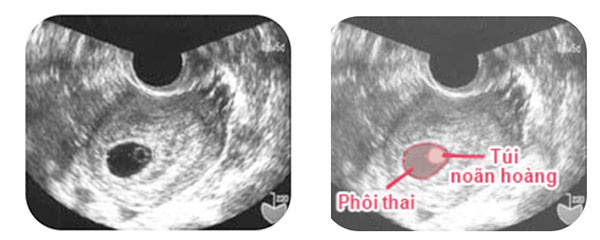 Ở tuần thai thứ 4 - 5 của thai kì sẽ thấy túi thai màu đen trong tử cung Ở tuần thai thứ 4 - 5 của thai kì sẽ thấy túi thai màu đen trong tử cung