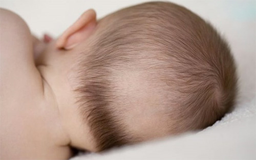 Trẻ sơ sinh bị thiếu Canxi tóc rụng vành khăn