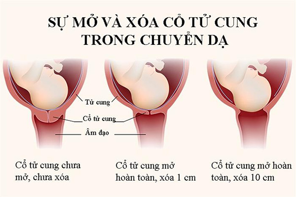 Cổ tử cung mở bao nhiêu thì sinh?